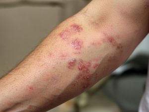 Eczema