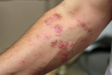 Eczema
