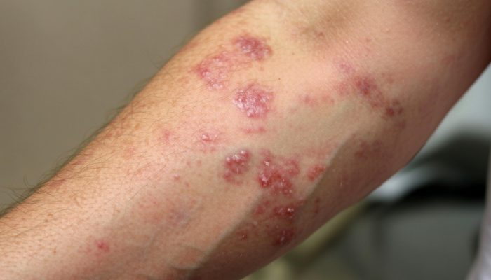 Eczema